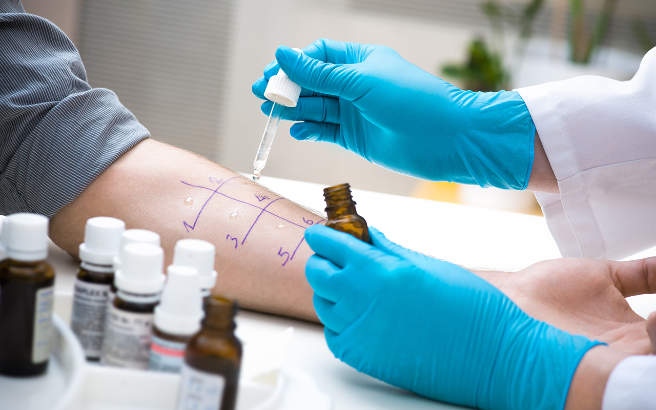 Skin prick allergy test